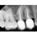 HD Digital Dental X-Ray Sensors (Rent to Own)